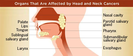 malnutrition_head_neck_cancer
